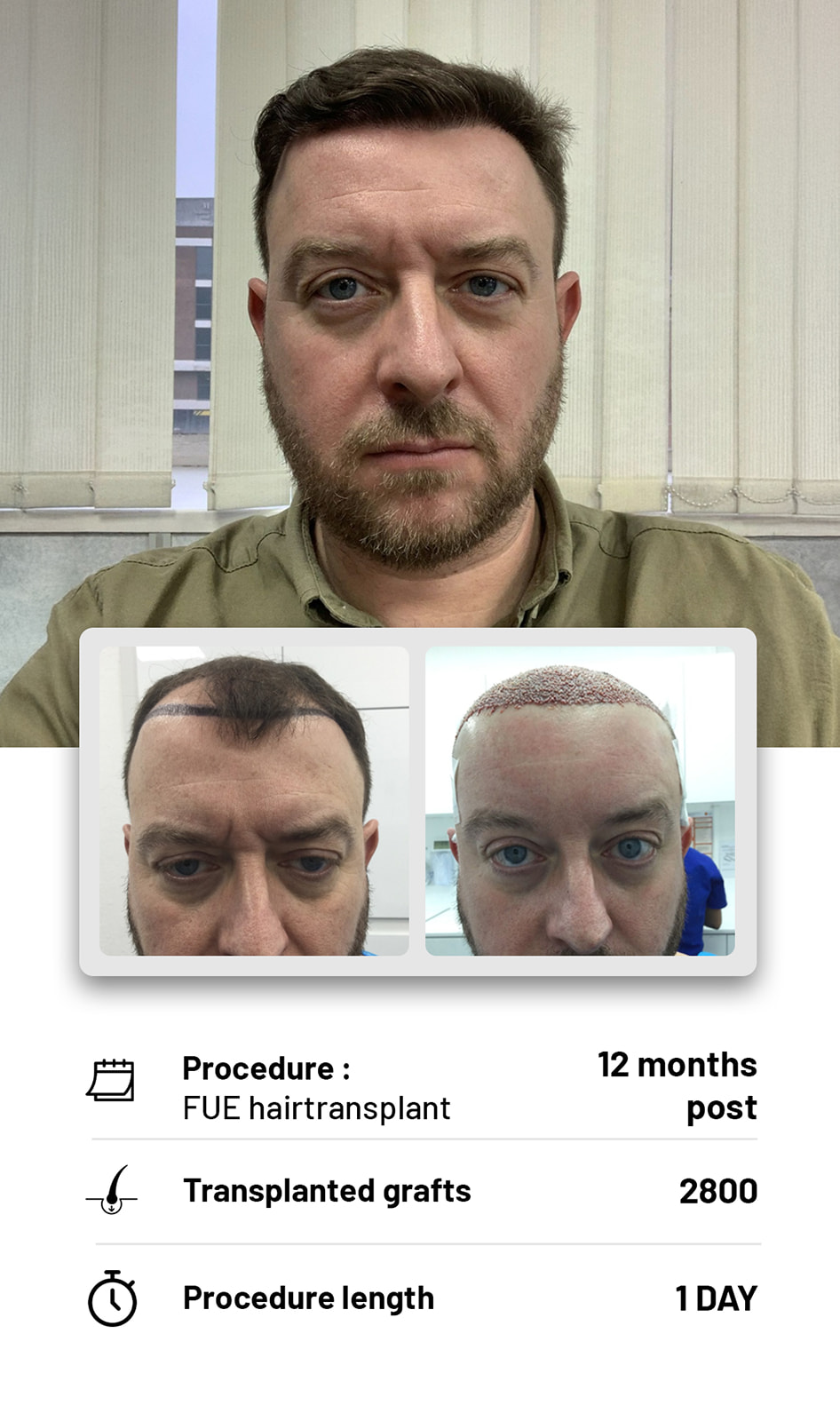 The Hair transplant hub