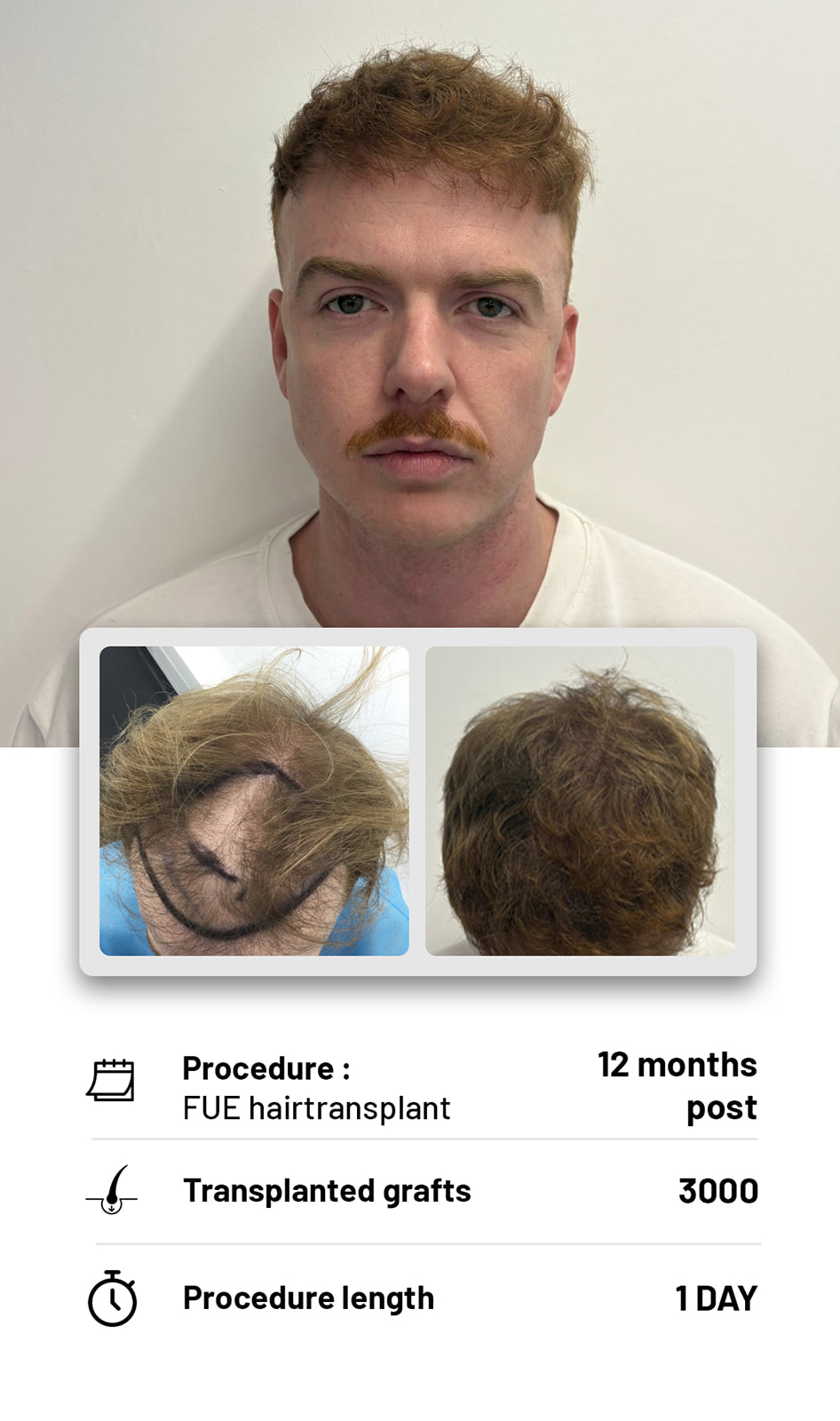The Hair transplant hub