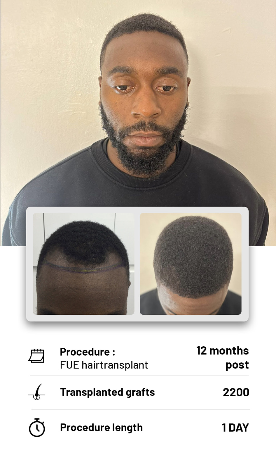The Hair transplant hub