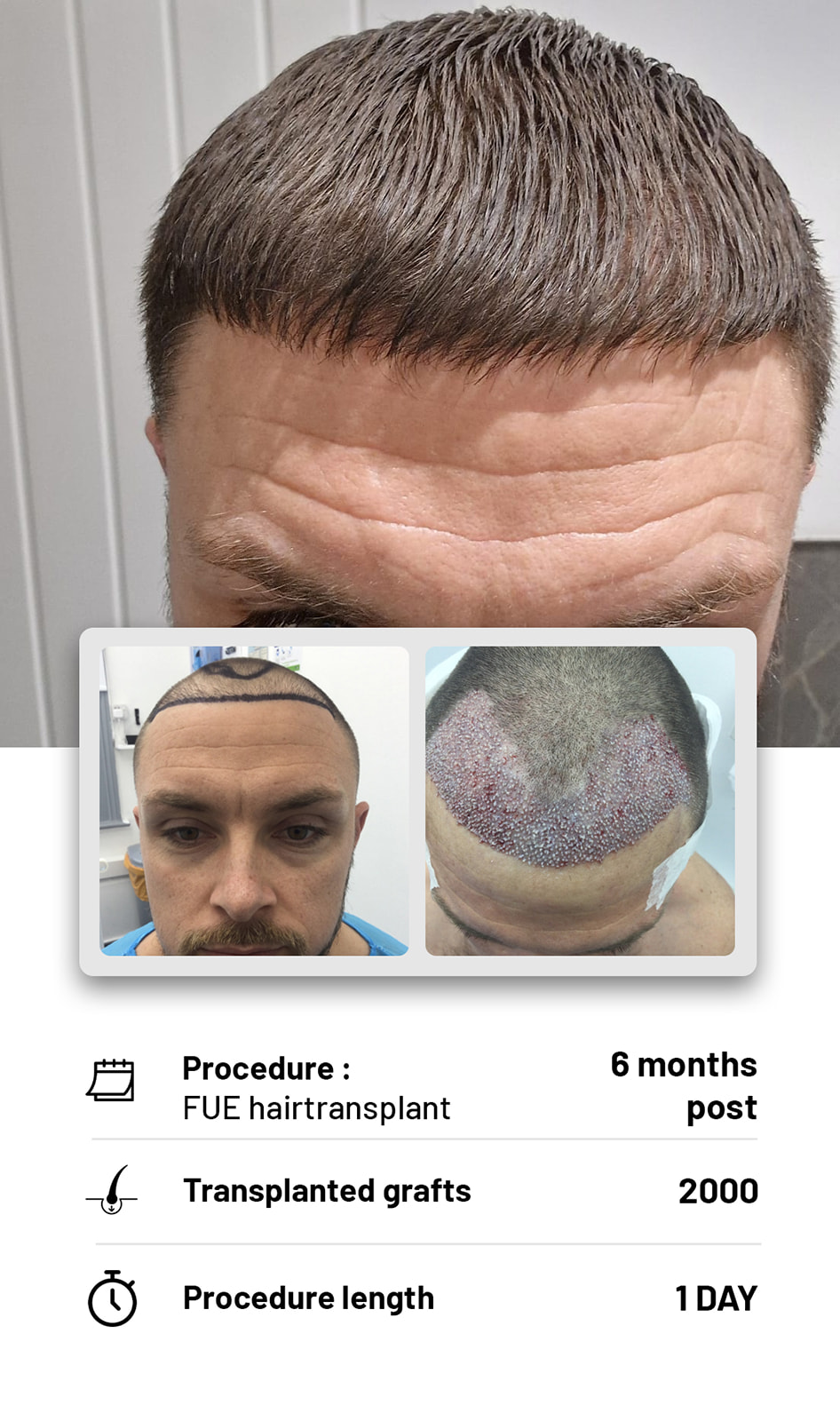 The Hair transplant hub