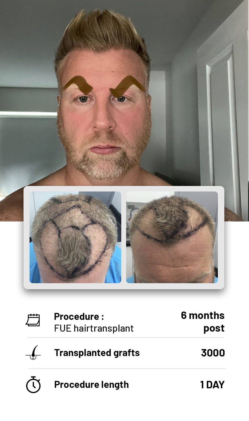 The Hair transplant hub