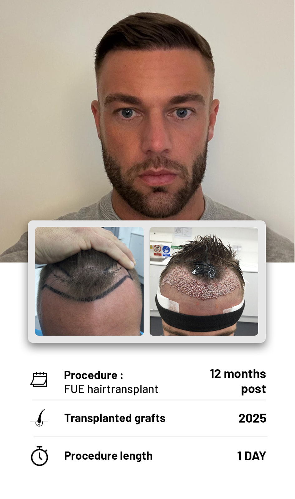 The Hair transplant hub