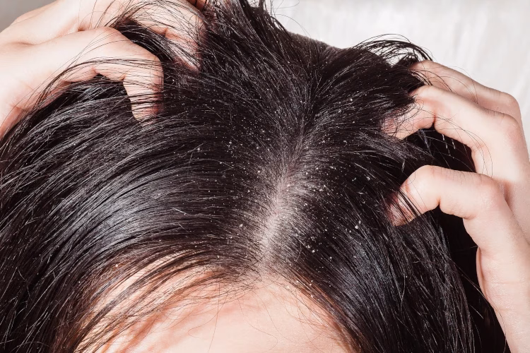 Does-Dandruff-Cause-Hair-Loss