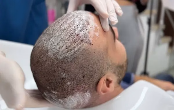 Hair Care After a Hair Transplant - The hairtransplant Hub UK