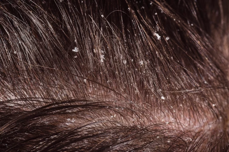 close-up-image-of-dandruff-in-a-mans-hair